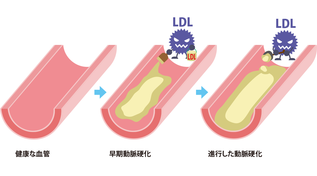 健康な血管、早期動脈硬化、進行した動脈硬化の例。